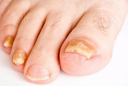 conspirații din ciuperci de pe unghiile picioarelor)